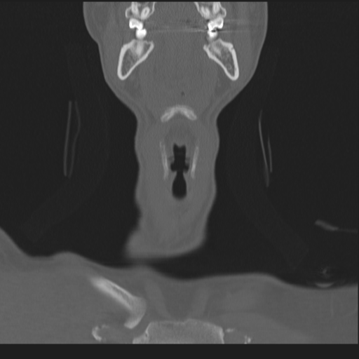 Bilateral locked facets (Radiopaedia 33850-35016 Coronal bone window 12).png
