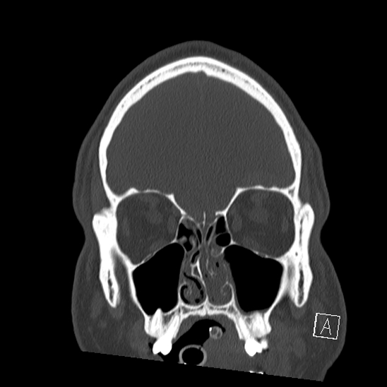 File:Bilateral occipital condyle fracture (type 2) (Radiopaedia 87675-104089 Coronal bone window 14).jpg