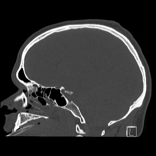 Bilateral occipital condyle fracture (type 2) (Radiopaedia 87675-104089 Sagittal bone window 64).jpg