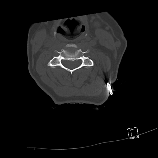 Bilateral occipital condyle fractures (type 3) (Radiopaedia 87672-104086 Axial bone window 39).jpg