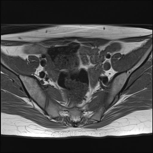 File:Bilateral ovarian endometriomas (Radiopaedia 87085-103347 Axial T1 7).jpg