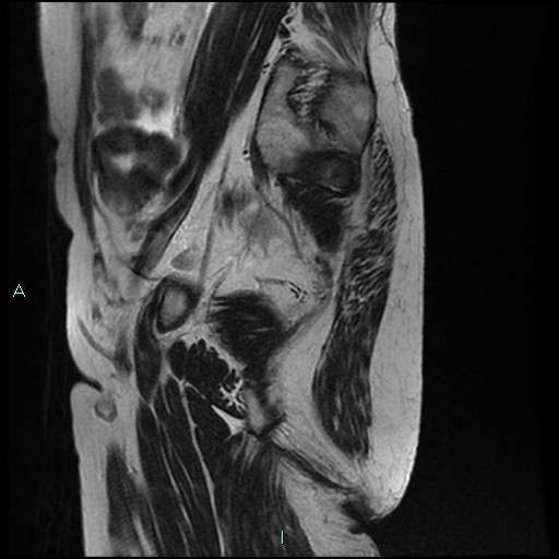 File:Bilateral ovarian fibroma (Radiopaedia 44568-48293 Sagittal T2 28).jpg