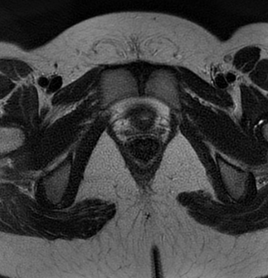 File:Bilateral ovarian fibrothecomas - adolescent (Radiopaedia 86604-102707 Axial T2 42).jpg