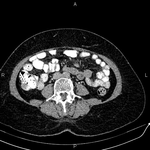 Bilateral ovarian serous cystadenocarcinoma (Radiopaedia 86062-101989 Axial C+ delayed 41).jpg