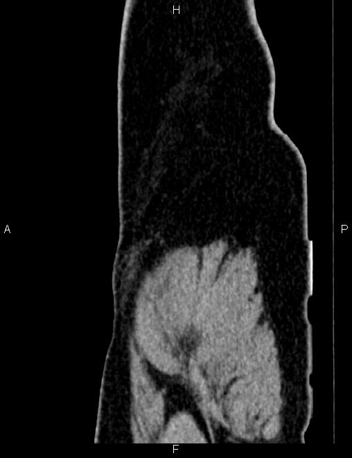 Bilateral ovarian teratoma (Radiopaedia 83131-97503 D 110).jpg