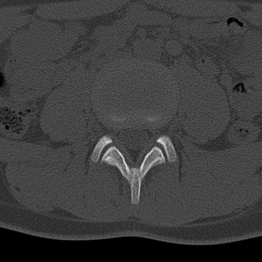 Bilateral pars defect (Radiopaedia 26691-26846 Axial bone window 16).jpg