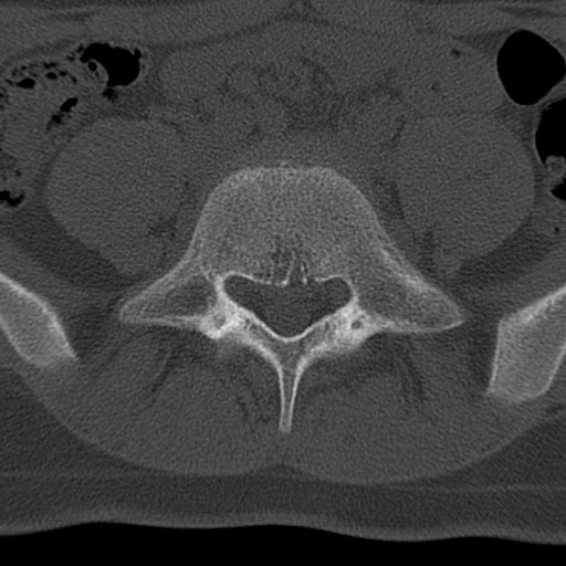 Bilateral pars defect (Radiopaedia 26691-26846 Axial bone window 54).jpg