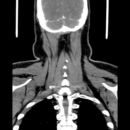 Bilateral peritonsillar abscess (Radiopaedia 85065-100610 Coronal 62).jpg