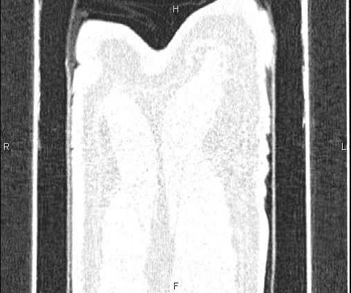 Bilateral pulmonary AVM (Radiopaedia 83134-97505 Coronal lung window 82).jpg