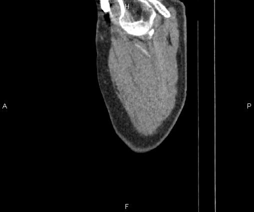 Bilateral pulmonary AVM (Radiopaedia 83134-97505 D 7).jpg