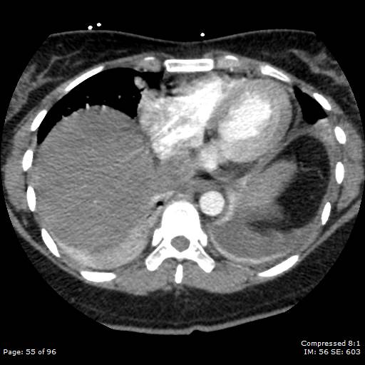 Bilateral pulmonary emboli with Hampton hump sign (Radiopaedia 54070-60246 Axial C+ CTPA 52).jpg