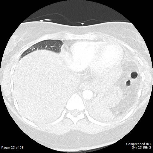 Bilateral pulmonary emboli with Hampton hump sign (Radiopaedia 54070-60246 Axial lung window 23).jpg