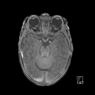 Bilateral subdural hemorrhage and parietal skull fracture (Radiopaedia 26058-26190 Axial T1 18).png