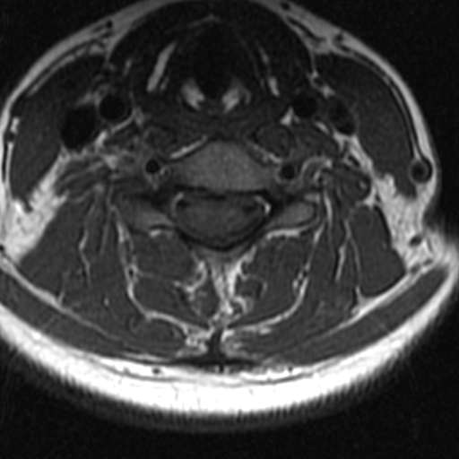 File:Bilateral tortuous vertebral arteries (Radiopaedia 19070-19039 Axial T2 7).jpg
