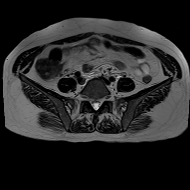 Bilateral tubo-ovarian abscesses (Radiopaedia 58635-65829 Axial T2 2).jpg