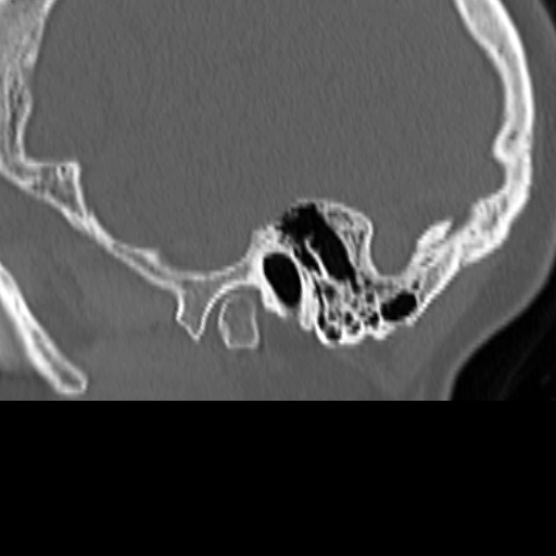 Bilateral tympanoplasty (Radiopaedia 16947-16664 Sagittal bone window 6).jpg
