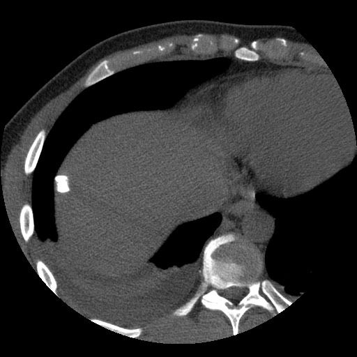Bile leak from liver traumatic laceration (Radiopaedia 63463-72077 Axial Biliscopin 7).jpg