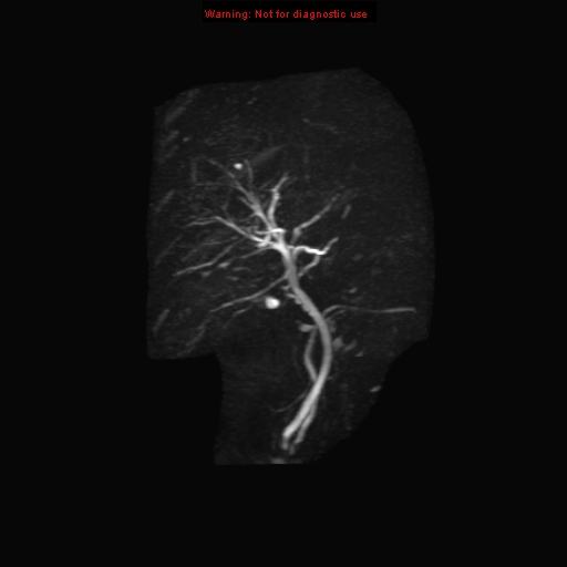 File:Biliary tree anatomical variant - biliary trifurcation (Radiopaedia 12531-12750 Coronal 3D MRCP 17).jpg