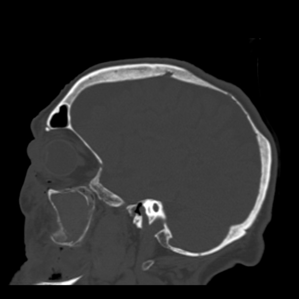 Biparietal osteodystrophy (Radiopaedia 46109-50463 Sagittal bone window 76).jpg