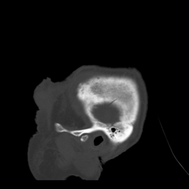 Biparietal osteodystrophy (Radiopaedia 46109-50463 Sagittal bone window 97).jpg