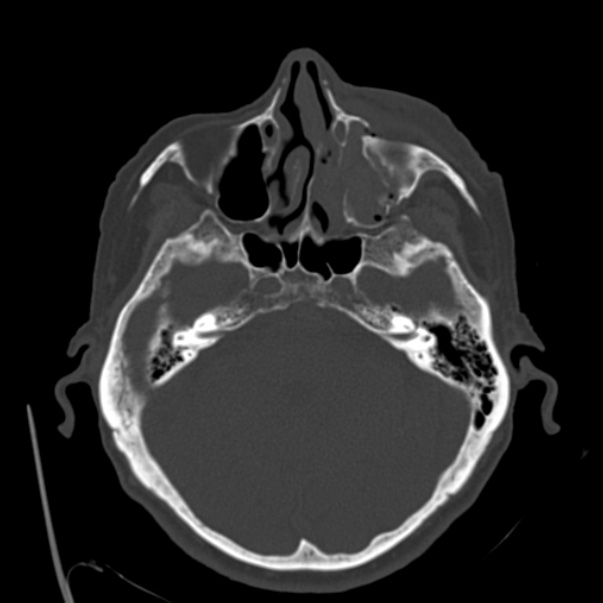 Biparietal osteodystrophy (Radiopaedia 46109-50463 bone window 21).jpg