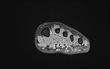 File:Bipartite hallux sesamoid diastasis (Radiopaedia 77133-89109 Coronal T2 fat sat 16).jpg