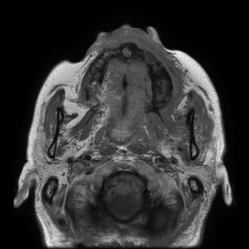 Bisphosphonate-related osteonecrosis of the maxilla (Radiopaedia 51367-57101 Axial T1 24).jpg