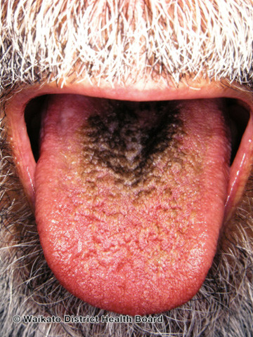 File:Black hairy tongue (DermNet NZ reactions-w-black-tongue01).jpg