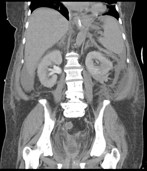 File:Bladder rupture post renal biopsy (Radiopaedia 30863-31572 Coronal non-contrast 38).jpg