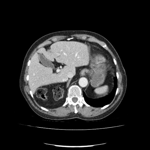 File:Bladder tumor detected on trauma CT (Radiopaedia 51809-57609 B 31).jpg