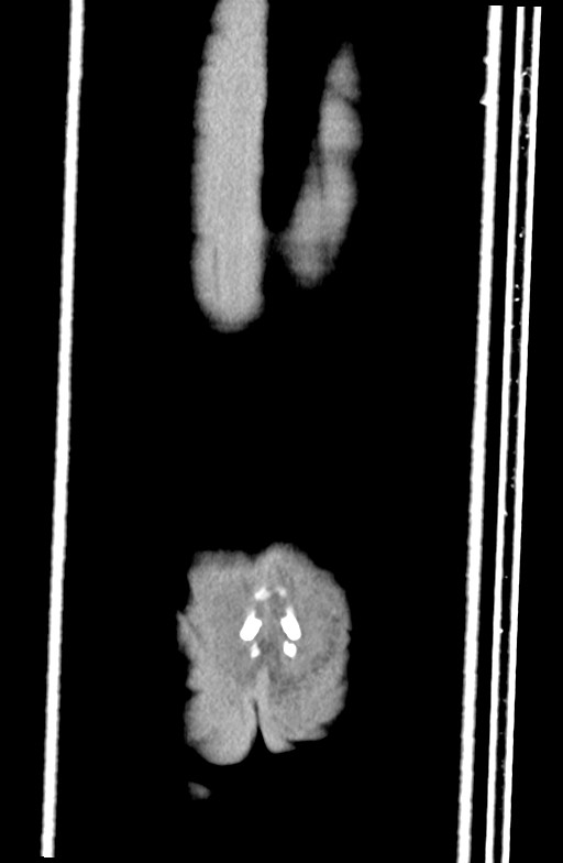 Blunt injury to the small bowel (Radiopaedia 74953-85987 B 95).jpg
