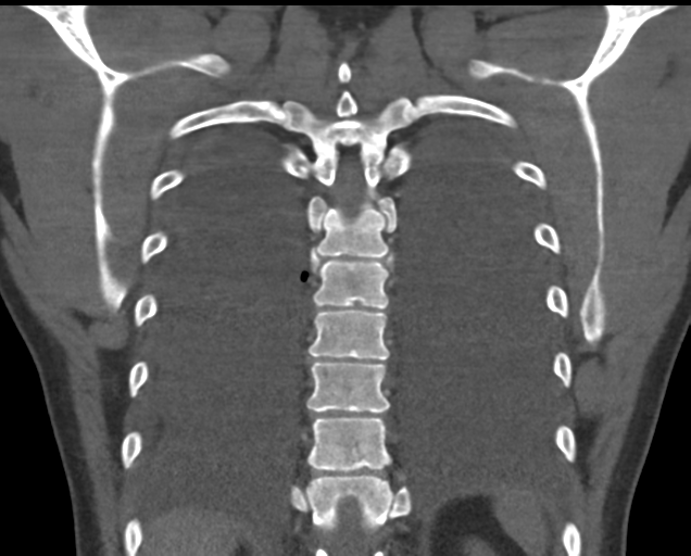 File:Boerhaave syndrome (Radiopaedia 39382-41660 C 72).png