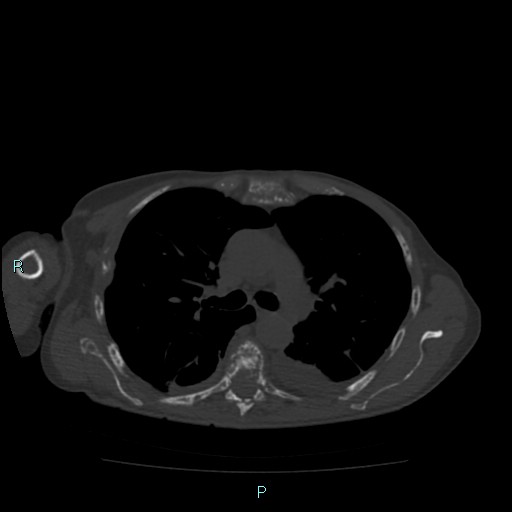 Bone metastases from untreated breast cancer (Radiopaedia 42973-46219 Axial bone window 41).jpg