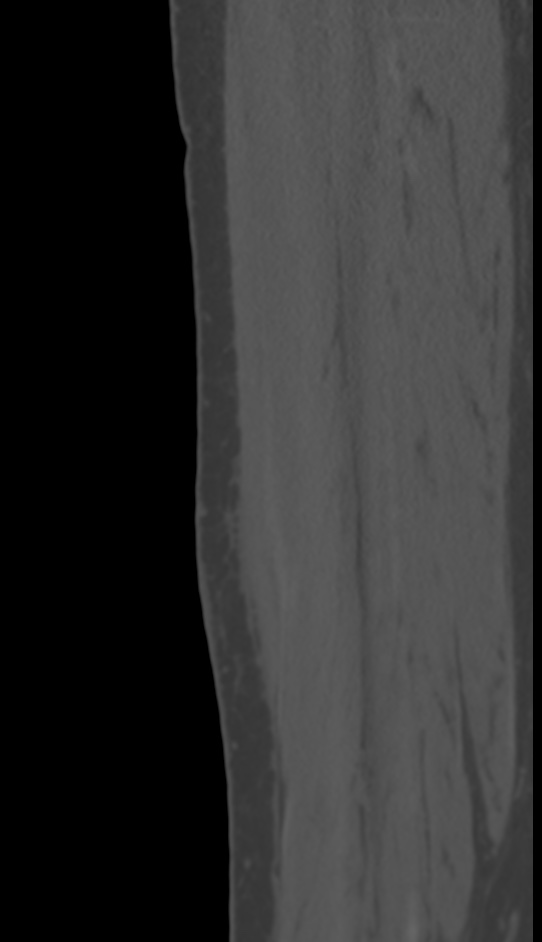 Bone metastasis - tibia (Radiopaedia 57665-64609 Sagittal bone window 134).jpg