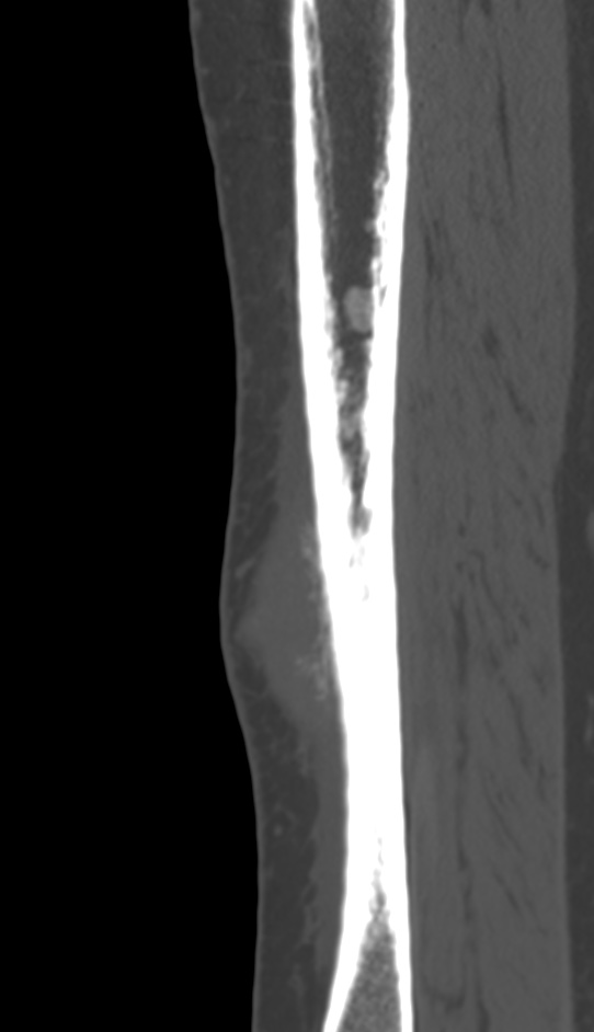 Bone metastasis - tibia (Radiopaedia 57665-64609 Sagittal bone window 54).jpg