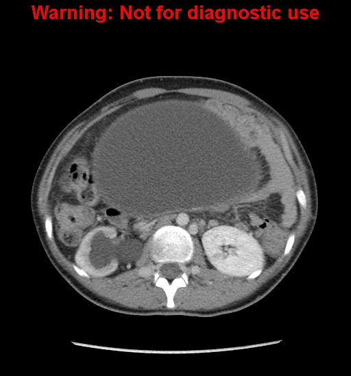 Borderline mucinous cystadenoma of ovary (Radiopaedia 25586-25767 A 12).jpg