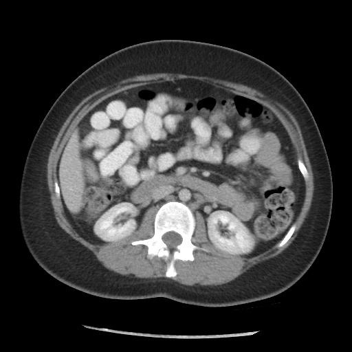 File:Borderline mucinous tumor (ovary) (Radiopaedia 78228-90808 A 86).jpg