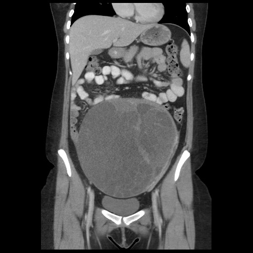 Borderline mucinous tumor (ovary) (Radiopaedia 78228-90808 C 22).jpg