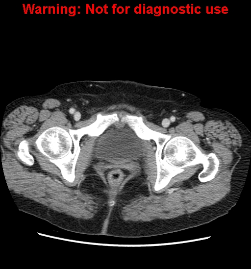 File:Bosniak renal cyst - type II (Radiopaedia 23404-23468 D 72).jpg