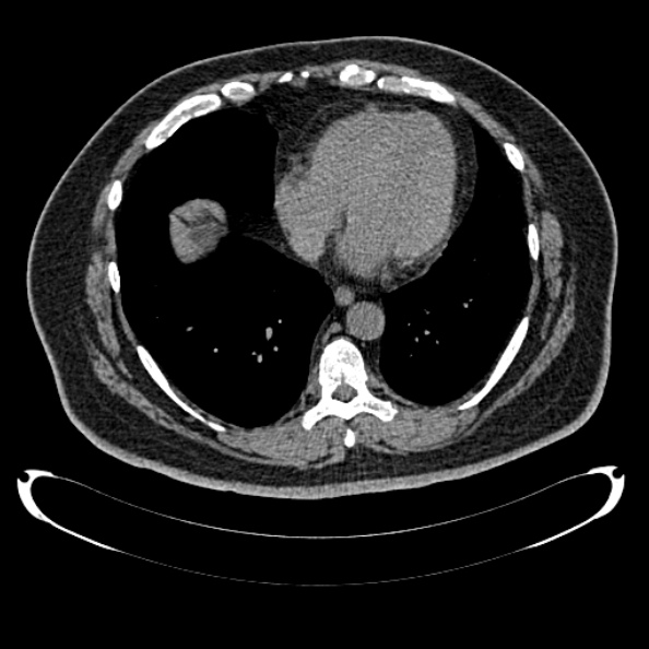 Bosniak renal cyst - type IV (Radiopaedia 24244-24518 Axial non-contrast 1).jpg