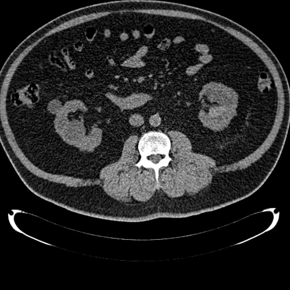 Bosniak renal cyst - type IV (Radiopaedia 24244-24518 Axial non-contrast 155).jpg