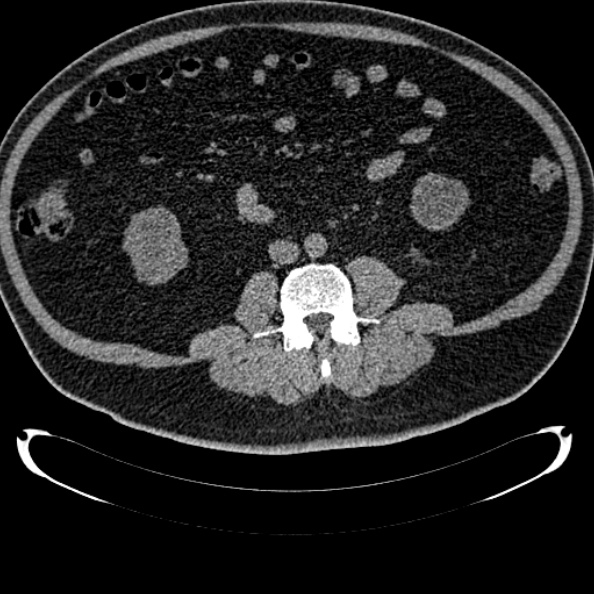 Bosniak renal cyst - type IV (Radiopaedia 24244-24518 Axial non-contrast 189).jpg