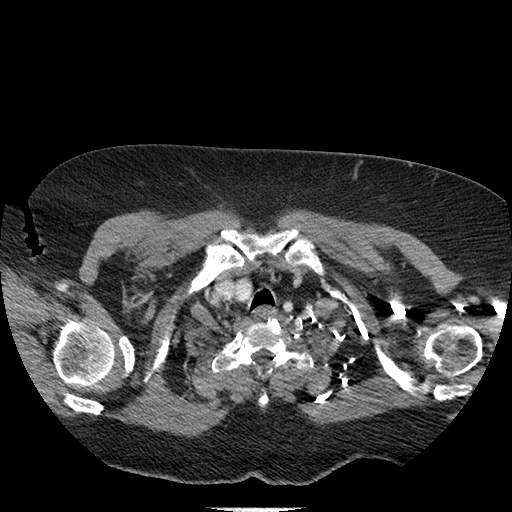 Bovine aortic arch - right internal mammary vein drains into the superior vena cava (Radiopaedia 63296-71875 A 6).jpg