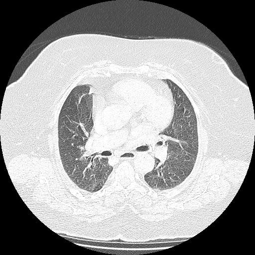 Bovine aortic arch - right internal mammary vein drains into the superior vena cava (Radiopaedia 63296-71875 Axial lung window 71).jpg
