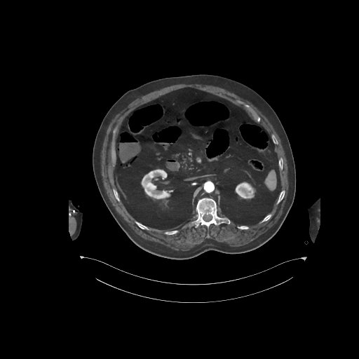 File:Bowel ischemia secondary to SMA occlusion with extensive portomesenteric venous gas (Radiopaedia 54656-60871 A 48).jpg