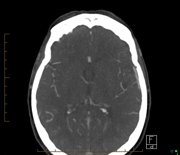 Brachiocephalic trunk stenosis (Radiopaedia 87242-103519 A 33).jpg