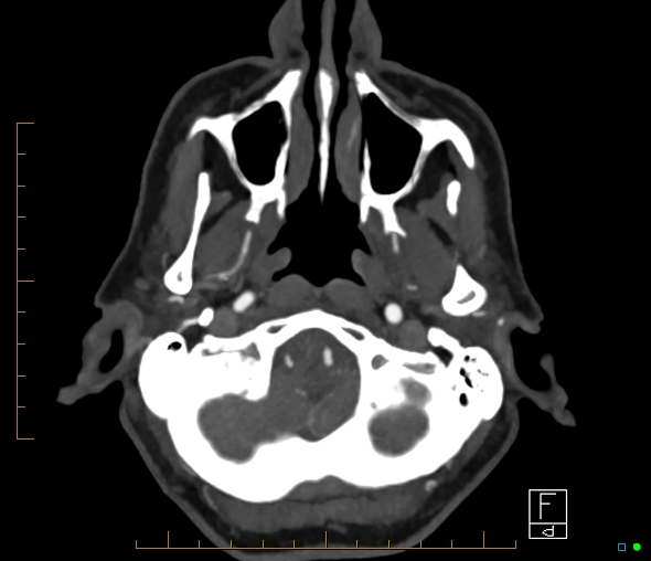 Brachiocephalic trunk stenosis (Radiopaedia 87242-103519 A 62).jpg