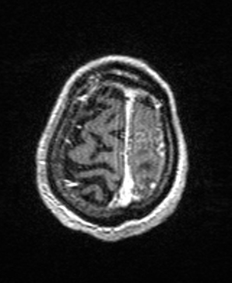 Brain abscess with dual rim sign (Radiopaedia 87566-103938 Axial T1 C+ 143).jpg