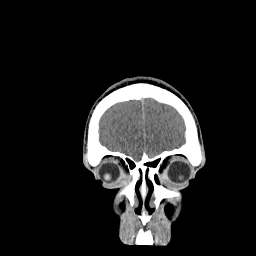 Brain death (Radiopaedia 78597-91360 Coronal non-contrast 11).jpg