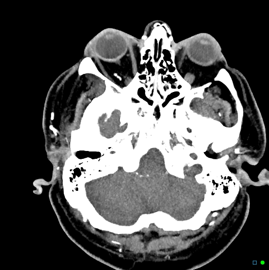 Brain death on MRI and CT angiography (Radiopaedia 42560-45841 B 42).jpg